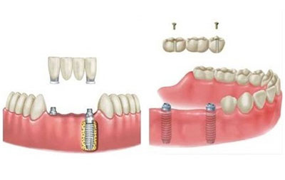 种植牙齿过程概述