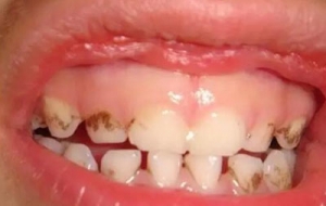 哪些原因可导致牙釉质发育不全