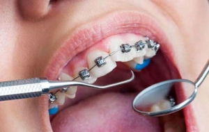 牙齿怎么矫正？牙齿矫正的过程