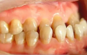 牙齿矫正为什么需要二年时间？