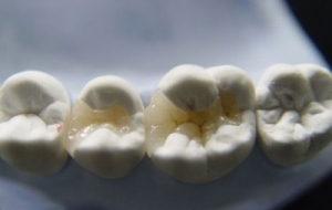 牙体修复类型及特点